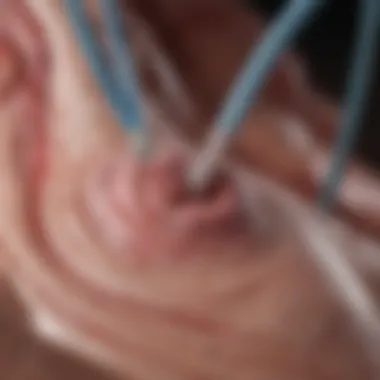 Catheter Placement in Coronary Ablation Illustration of coronary ablation technique highlighting catheter placement in the heart.