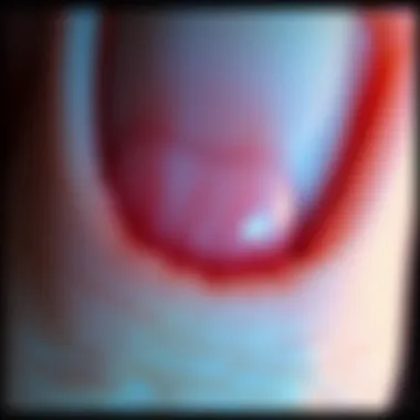 Illustration of subungual melanoma characteristics