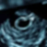 Illustration of ultrasound waves demonstrating precision