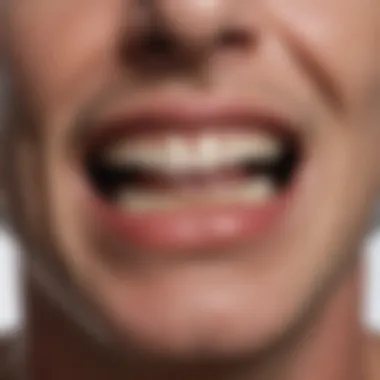 Aesthetic Appeal in Clinical Use of Suction Dentures Aesthetic appeal of suction dentures in a clinical setting