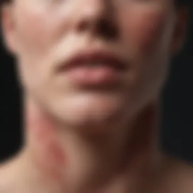 Depiction of advanced eczema symptoms illustrating severe skin condition.