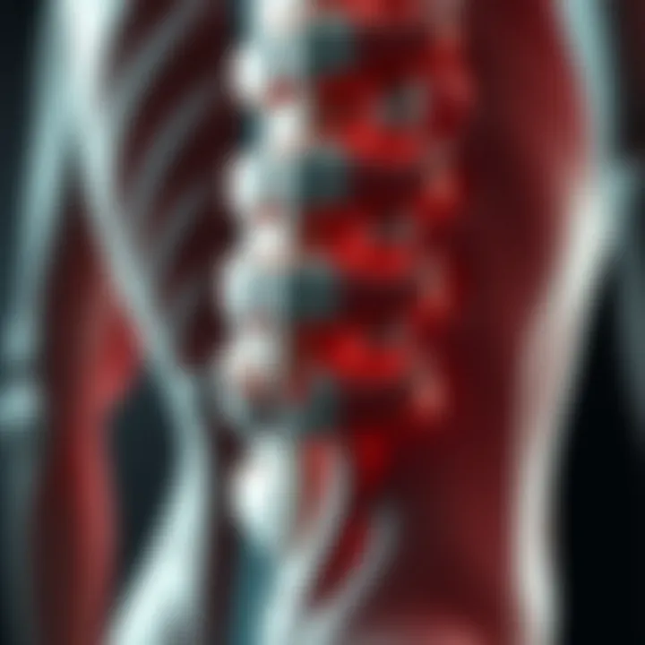 Illustration of paraspinal musculature showing fatty atrophy