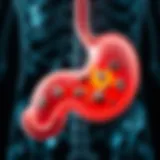 Illustration of gallbladder anatomy highlighting stone formation areas
