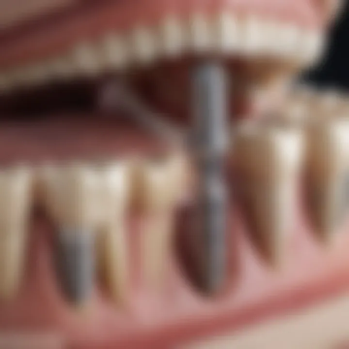 Schematic representation of dental implant components
