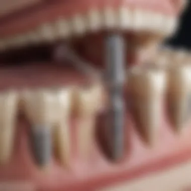 Components of Dental Implants Schematic representation of dental implant components